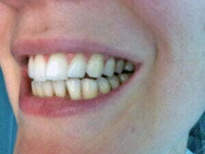 doos dwaas aanvulling Test: Maakt kurkuma je tanden witter? - HetkanWEL